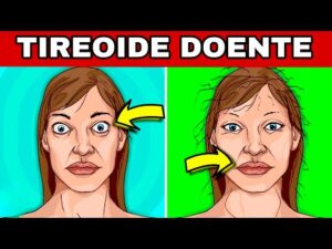 8 SINAIS ALARMANTES de TIREOIDE DOENTE (Hipotireoidismo e Hipertireoidismo)