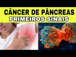 7 Sinais Iniciais de CÂNCER de PÂNCREAS (Sintomas de Insulinoma)