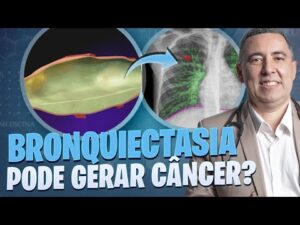 BRONQUIECTASIA pode ocasionar em Câncer? Pneumologista responde