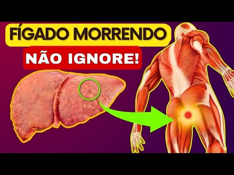 13 Sinais Perigosos de FÍGADO DOENTE (Sintomas de Insuficiência Hepática  Gordura no Fígado)