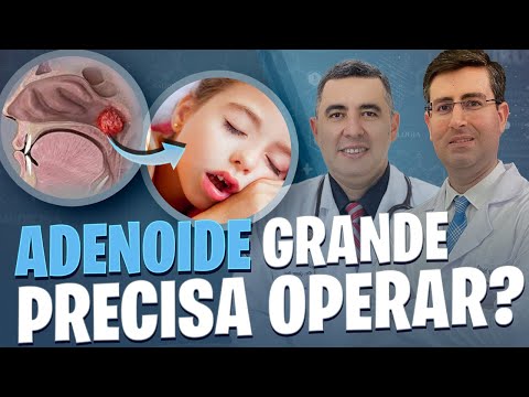 Quando uma criança precisa OPERAR a ADENOIDE? Pneumologista e Otorrino respondem