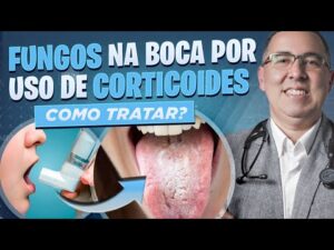 Qual o TRATAMENTO para FUNGOS na boca (Candidíase ORAL) por causa do uso de CORTICOIDE ORAL